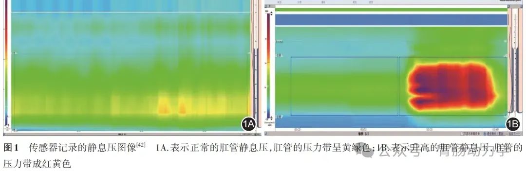 结直肠肛门测压专家共识-指导标准化流程(图2) 微信图片_20250718175935.jpg