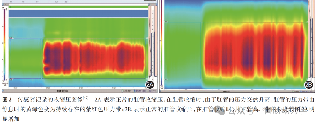 结直肠肛门测压专家共识-指导标准化流程(图3) 微信图片_20250718175937.png