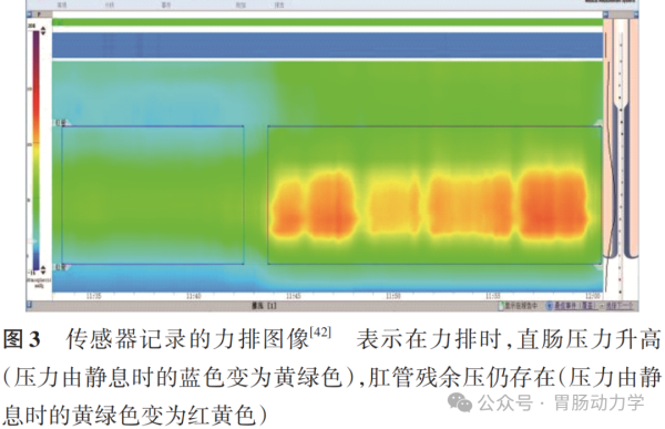 结直肠肛门测压专家共识-指导标准化流程(图4) 微信图片_20250718175940.png