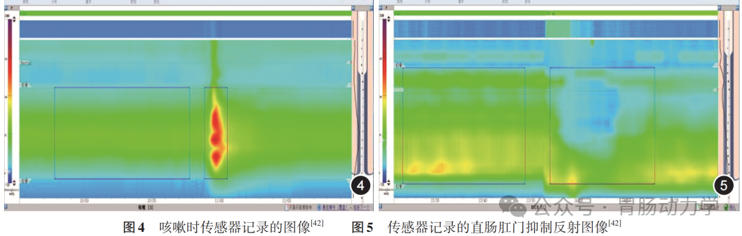结直肠肛门测压专家共识-指导标准化流程(图5) 微信图片_20250718175943.png