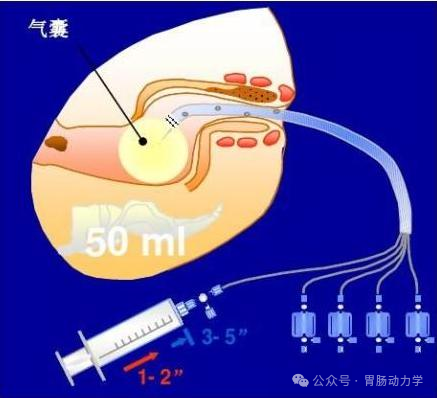 结直肠肛门测压专家共识-指导标准化流程(图1) 微信图片_20250718175932.png